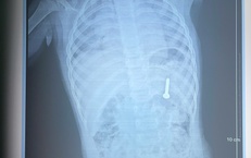 Bé 21 tháng tuổi nuốt phải đinh vít dài khoảng 2,5cm