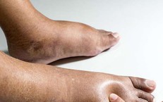 Chân voi là bệnh gì, có nguy hiểm không?