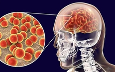 Não mô cầu gây tử vong nhanh, người dân cần làm gì để tự bảo vệ?