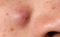 Có nên nặn mụn nhọt ở mặt không? những sai lầm dễ gây biến chứng