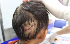 Bé 4 tuổi bị chó nhà cắn, nhiều vết thương nặng ở đầu và tay