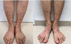 Viêm da do bọ chét: Dấu hiệu nhận biết sớm và cách xử lý tránh nhiễm trùng