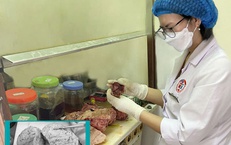 Người phụ nữ 46 tuổi mang trong mình khối u tử cung khổng lồ nặng 5kg