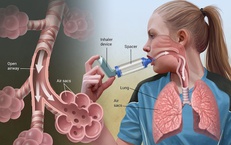 Triệu chứng thường gặp và các mức độ khó thở ở hen suyễn