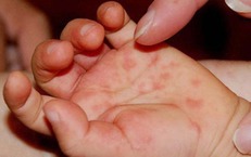 Cha mẹ cần làm gì khi tay chân miệng lây lan trong trường học?