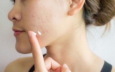 6 sai lầm khi chữa mụn trứng cá