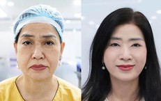 Căng da mặt - khi trẻ hóa không còn là 'kéo da' đơn thuần