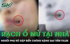 Rạch ổ mủ tại nhà, người phụ nữ gặp biến chứng nặng sau tiêm filler