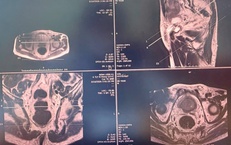 Sinh thiết đích qua tầng sinh môn, bệnh nhân ung thư tiền liệt tuyến được can thiệp kịp thời, điều trị ổn định