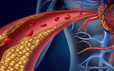 Cholesterol cao không chỉ do ăn dầu mỡ, nguyên nhân chính thường bị bỏ qua