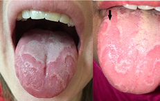 6 lưu ý về viêm lưỡi bản đồ ở trẻ em