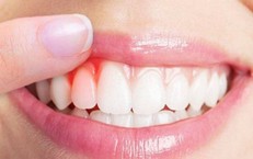 Nguyên nhân thường gặp gây chảy máu miệng và cách xử trí tại nhà