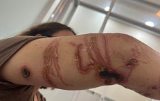 Cách xử trí đúng ban đầu bị sứa đốt khi đi du lịch biển