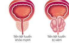 Viêm tuyến tiền liệt có dễ phát hiện không?