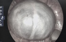 Chủ quan với cơn đau bụng, phát hiện u buồng trứng 14cm