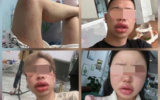 Sưng mắt, môi sau khi ăn bánh trứng kiến: Đặc sản hay 'thủ phạm'?