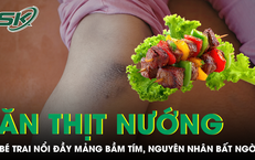 Bé trai nổi đầy mảng bầm tím sau bữa ăn thịt nướng, bác sĩ phát hiện nguyên nhân bất ngờ