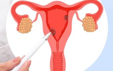 Hội chứng buồng trứng chuyển hóa đa nội tiết - tên gọi mới của hội chứng buồng trứng đa nang