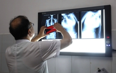 Dấu hiệu nhiều phụ huynh bỏ qua khiến trẻ biến dạng cột sống