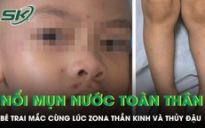 Bé trai 4 tuổi nổi kín mụn nước toàn thân sau khi mắc cùng lúc zona thần kinh và thủy đậu