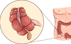 Viêm ruột thừa dễ nhầm lẫn và có thể gây biến chứng gì?