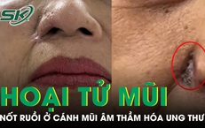Nốt ruồi ở cánh mũi âm thầm hóa ung thư, phá hủy gần toàn bộ mũi người phụ nữ