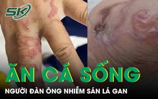 Ăn cá sống, người đàn ông bị nhiễm sán lá gan