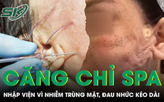 Căng chỉ nâng cơ ở spa, người phụ nữ nhập viện vì nhiễm trùng mặt