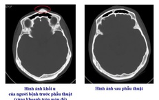 Bệnh viện Việt Nam - Thụy Điển Uông Bí phẫu thuật thành công ca u xương sọ hiếm gặp