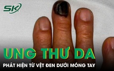 Bàng hoàng phát hiện ung thư da từ vệt đen dưới móng tay