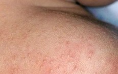 Mùa hè nhiều rôm sảy cần xử trí ra sao?