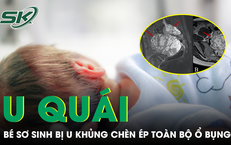 Cứu trẻ sơ sinh 10 ngày tuổi mang khối u hiếm gặp, chèn ép toàn bộ ổ bụng
