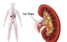Nhập viện vì sỏi thận, chuyên gia khuyến cáo cần phát hiện sớm khi có biểu hiện này
