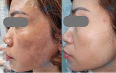 Bác sĩ chỉ rõ lý do nhiều người trị nám tốn kém nhưng vẫn tái phát