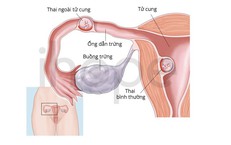 Hiếm gặp: Vừa có thai trong tử cung vừa có thai ngoài tử cung