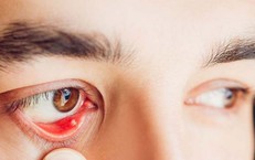 Nguyên nhân gây cộm mắt và cách khắc phục