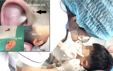 Hi hữu ca rò luân nhĩ di truyền qua 3 thế hệ