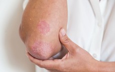 Người mắc bệnh vảy nến đối mặt áp lực tâm lý kéo dài nhiều năm