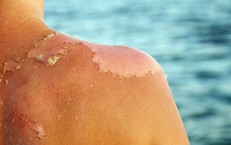 Bỏng nắng phải làm gì để tránh tổn thương da nghiêm trọng?