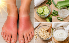 5 cách tự nhiên giúp làm dịu, cải thiện tình trạng cháy nắng ở bàn chân