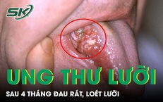 Loét lưỡi suốt 4 tháng, người đàn ông phát hiện ung thư ở tuổi 33 