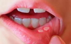 Phân biệt nhiệt miệng và ung thư lưỡi: Cách nhận biết sớm căn bệnh nguy hiểm
