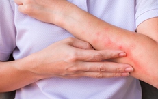 Nắng nóng khiến nguy cơ viêm da gia tăng, phòng ngừa thế nào?