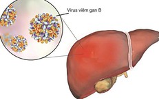 Viêm gan B có lây qua ăn uống, ôm hôn không và cách phòng tránh