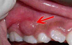 Cảnh báo biến chứng nguy hiểm của áp xe răng