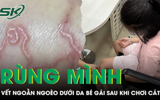 Tá hỏa phát hiện bắp chân bé gái 9 tuổi đầy vết ngoằn ngoèo bất thường