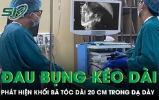 Bé gái 11 tuổi đau bụng kéo dài phát hiện khối bã tóc dài 20 cm trong dạ dày 