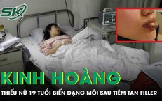 Thiếu nữ 18 tuổi biến dạng môi sau tiêm tan filler tại cơ sở thẩm mỹ chui