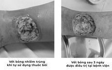 Tự chữa bỏng bằng thuốc dân gian, người đàn ông suýt hoại tử chân