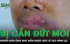 Người đàn ông bị cắn mất môi phải trải qua ca tạo hình phức tạp 